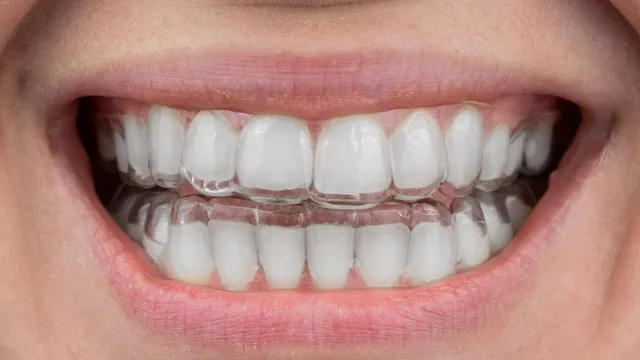 Clear Aligners Overview